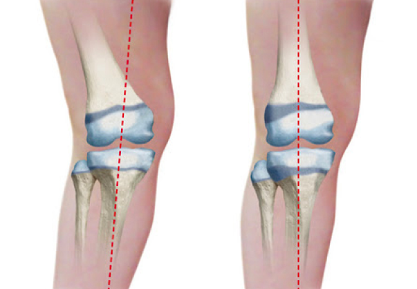 OrthoOne - Spine - Spinal Fracture Surgeries